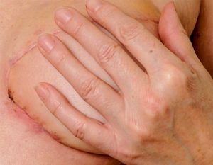 OUR SERVICES 6 Breast Reconstruction