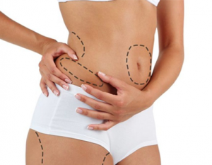 OUR SERVICES 8 Liposuction Dr Guna Plastic Surgeon Ipoh
