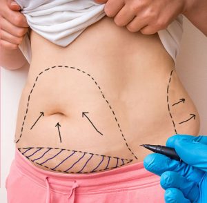 OUR SERVICES 9 Tummy_Tuck Dr Guna Plastic Surgeon Ipoh