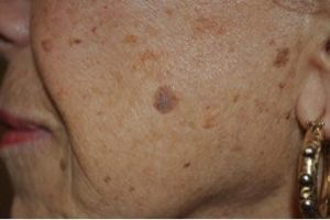 Removal of Lesions. 1 seborrheic-keratoses