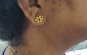 Removal of Lesions. 3 seborrheic-keratoses