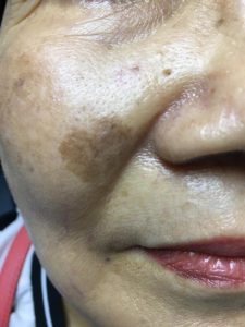 Pigment Laser Treatment 5 Lentigine