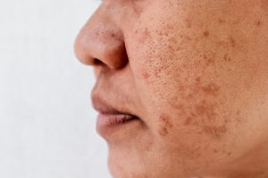 Pigment Laser Treatment 4 Melasma