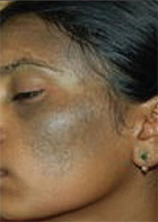 Pigment Laser Treatment 2 Nevus of Ota